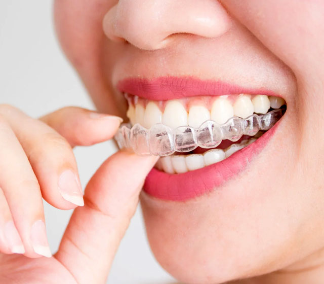 Invisalign