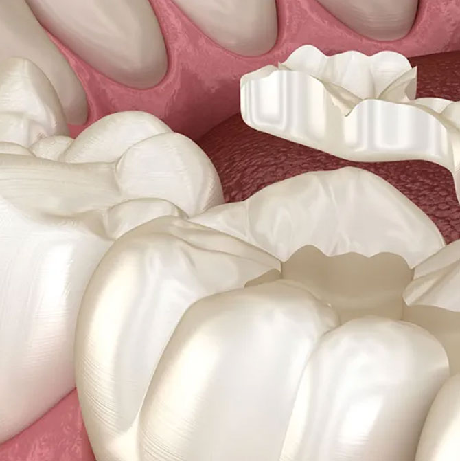 Restaurações-Onlays-e-Inlays-em-Campinas Lente de Contato Dental em Campinas
