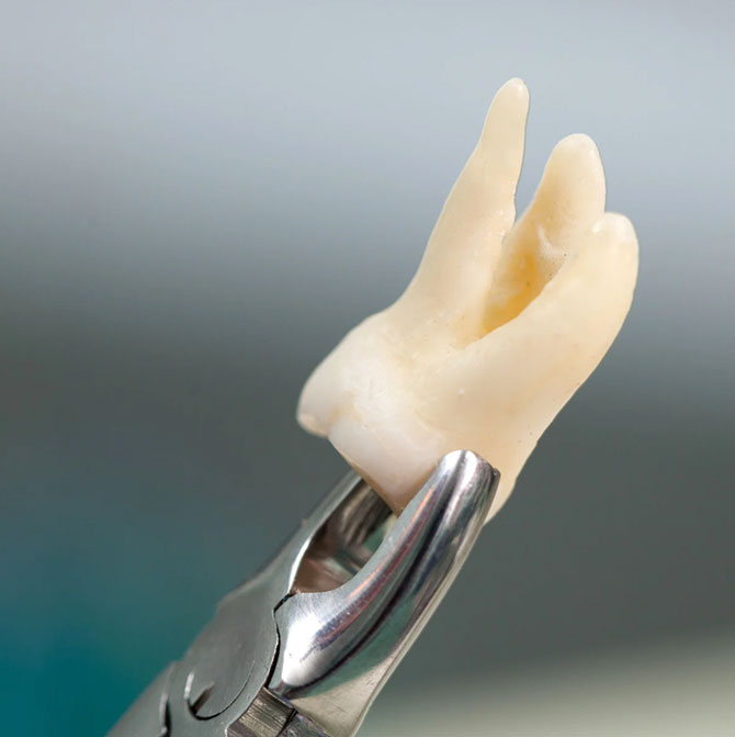 cirurgia-do-siso-em-campinas-sp