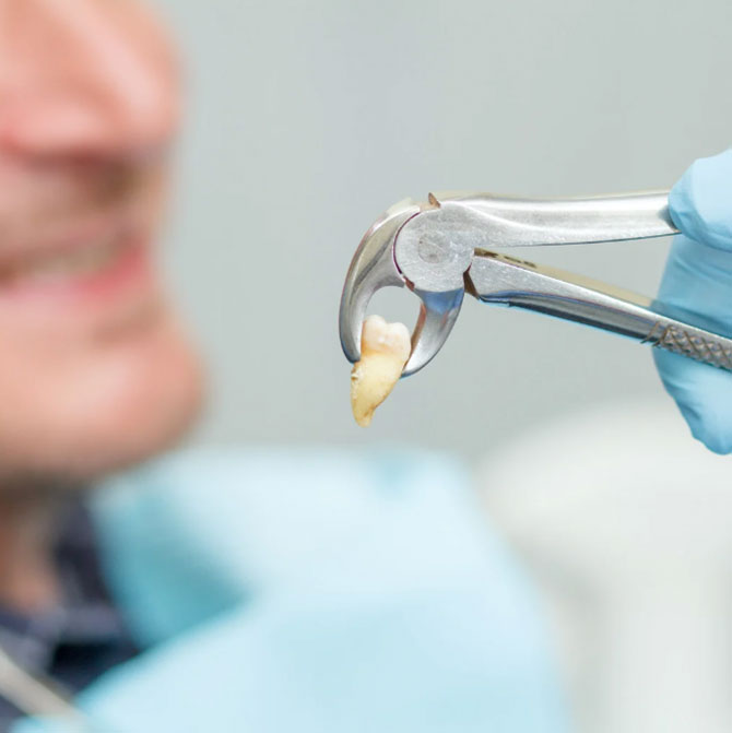 extracao-de-dente