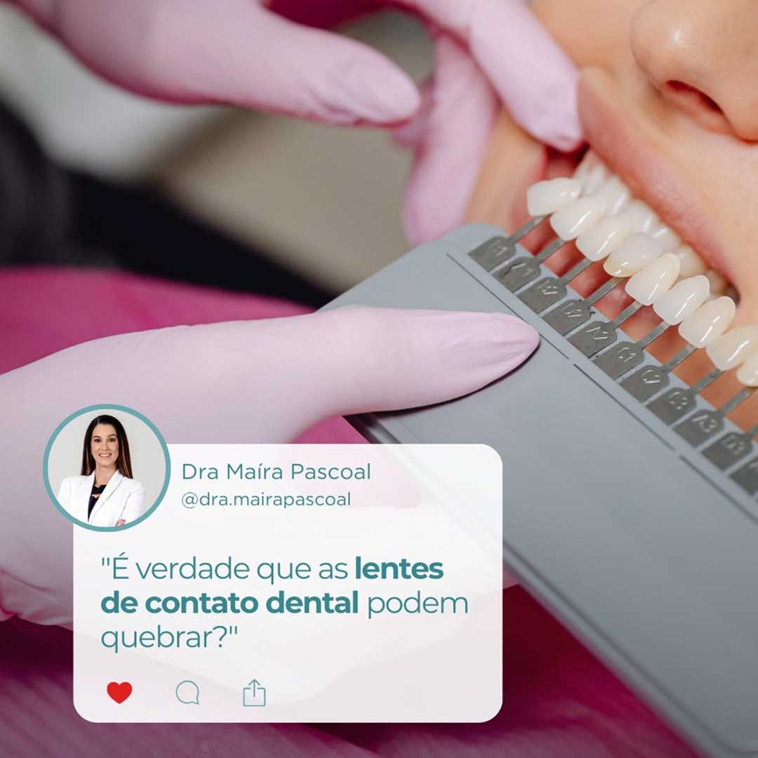Lentes de contato dental podem quebrar?