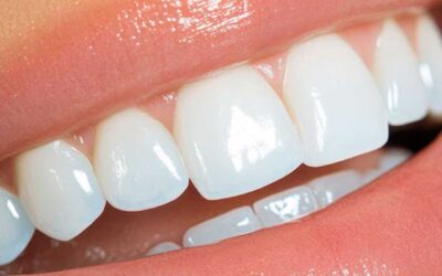 Lentes de contato dental: conheça o processo tecnológico realizado no consultório